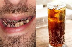 Hàm răng chàng trai thối rữa do nghiện loại đồ uống quen thuộc