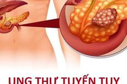 Cảnh báo những thói quen xấu gây ung thư tụy