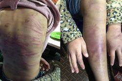 UBND TP Hà Nội chỉ đạo khẩn vụ bé gái 12 tuổi nghi bị bạo hành, xâm hại tình dục