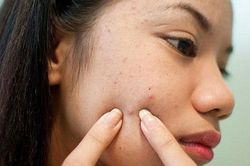Tác hại của nặn mụn sai cách