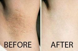 5 công thức hết thâm nách tại nhà bạn gái bắt buộc phải biết
