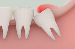 Đau do mọc răng khôn đừng lo chỉ cần có thứ này khỏi ngay sau 5 phút