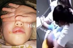 Vết sưng môi của bé gái 6 tuổi phơi bày cảnh phẫn nộ ở phòng khám nha khoa