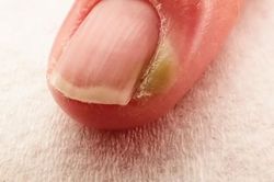 Xử trí khi bị chín mé
