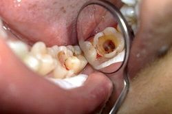 Sâu răng và tất cả những điều bạn cần biết