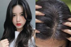 Vì sao ngày càng nhiều người trẻ bị bạc tóc?