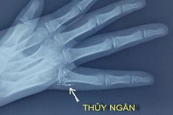 Hy hữu trẻ bị nhiễm độc thủy ngân qua da