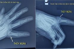 Sơ ý làm vỡ nhiệt kế, bé gái 11 tuổi bị nhiễm độc thủy ngân