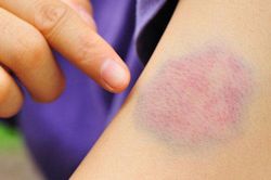 Cách xóa vết bầm tím trên cơ thể bằng phương pháp đơn giản
