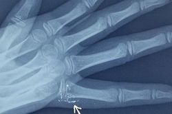 Một cháu bé bị nhiễm độc thủy ngân