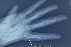 Trẻ bị nhiễm độc thủy ngân vì vỡ nhiệt kế