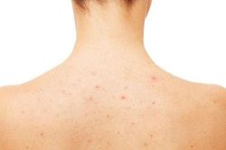 4 loại nước tắm vào sạch mụn, hết viêm lỗ chân lông