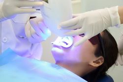 Tẩy trắng răng bằng laser thế nào?