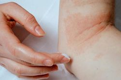 Cách giảm ngứa khi bị eczema