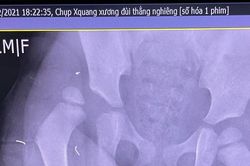 Sức khỏe bé gái 2 tuổi rơi từ tầng 12A chung cư hiện ra sao?