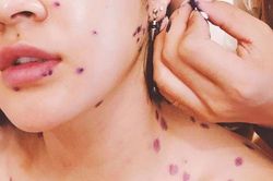 Bệnh thủy đậu ở người lớn nguy hiểm như thế nào?