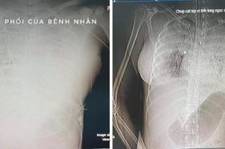 TP. HCM: Một phụ nữ tử vong sau một tuần tiêm filler nâng ngực