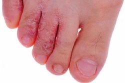 Trời nồm ẩm, cẩn thận bệnh nấm da