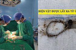 Bé trai 6 tuổi nuốt khối kim loại có nam châm gây thủng ruột