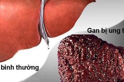 Cô gái 32 tuổi sốc khi phát hiện ung thư gan sau khi có biểu hiện mẩn ngứa, khô mắt
