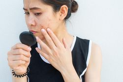 5 cách giúp bạn trị sẹo thâm
