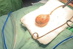 Cụ bà bỏ quên ống sonde 9 năm trong cơ thể, sỏi bám to như quả trứng