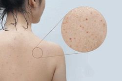 3 cách trị mụn ở lưng có thể bạn chưa biết