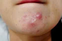 Mụn bọc và tất cả những điều bạn cần biết