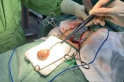 Cụ bà bỏ quên ống thông niệu quản 9 năm trong người