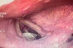 Cứu sống bệnh nhân 71 tuổi bị hóc xương lợn