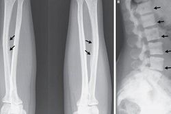 Uống quá nhiều trà làm xương bị vôi hóa