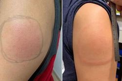 Hiện tượng tay sưng đỏ sau khi tiêm vaccine COVID-19 của Moderna