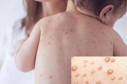 Sai lầm dễ gặp khi dùng thuốc trị thủy đậu