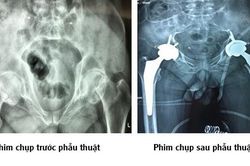 Uống rượu, hút thuốc lá lâu năm người đàn ông gãy 2 bên khớp háng cùng lúc chỉ với một cú ngã nhẹ