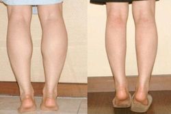Phương pháp thu nhỏ bắp chân đơn giản nhưng không nhiều người biết
