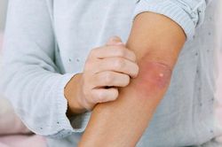Căn bệnh khiến người mắc nổi bóng nước toàn thân