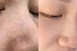 Cách nặn mụn đầu đen không để lại sẹo thâm