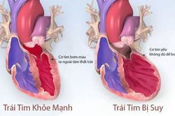 Thuốc dapagliflozin có thể làm giảm các biến cố suy tim