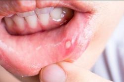 Khắc phục chứng nhiệt miệng