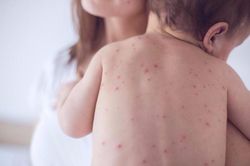 Hai trẻ sơ sinh nguy kịch do mắc thủy đậu ngay khi chào đời