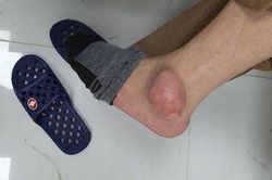 Chân nổi cục to như quả ổi vì sai lầm nhiều người mắc khi chữa gout
