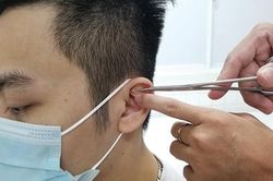 Nhĩ châm, cứu tinh cho người cai thuốc lá