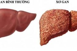 Có 4 triệu chứng này khi uống rượu, bạn cần đi khám xơ gan ngay lập tức
