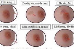 Cách sờ nắn đơn giản giúp phát hiện sớm ung thư vú mà bạn nên biết