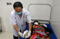 Tự chế pháo nổ, học sinh lớp 11 phải cắt cụt tay
