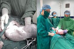 Bé gái chào đời vẫn cựa quậy trong bọc ối