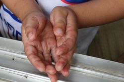 Bình Định: 1 bệnh nhi tử vong nghi do bệnh chân tay miệng