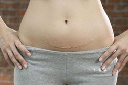 6 điều mẹ trẻ phải biết sau khi sinh mổ