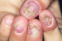 Có phải bị nấm móng?