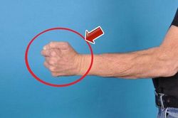 Hạ cao huyết áp 'cấp tốc'- mất 10 phút mà cứu cả một đời người
